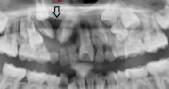 Abnormal Development Johor Bahru (JB) | Dental Clinic Johor Bahru (JB) | Children Friendly Dentist Johor Bahru (JB) | Invisalign Johor Bahru (JB)